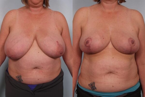 Breast Reduction 58