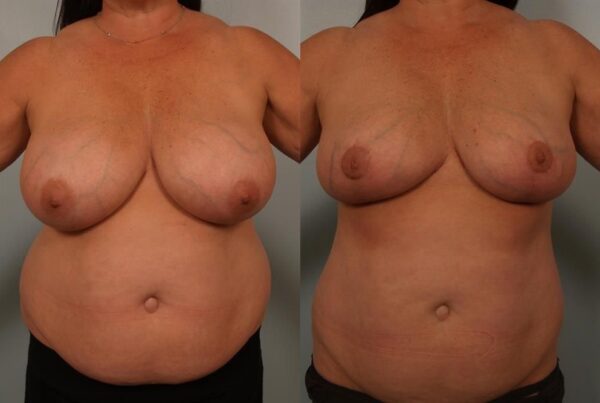 Breast Reduction 59