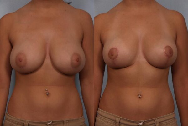 Breast Reduction 6