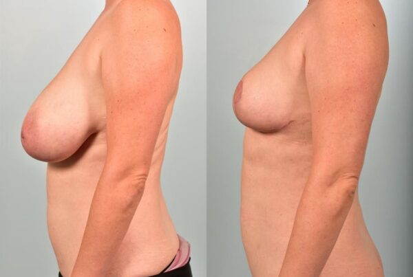 Breast Reduction 60