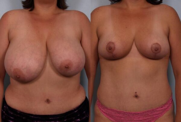 Breast Reduction 61