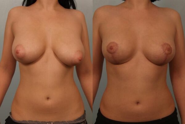 Breast Reduction 62