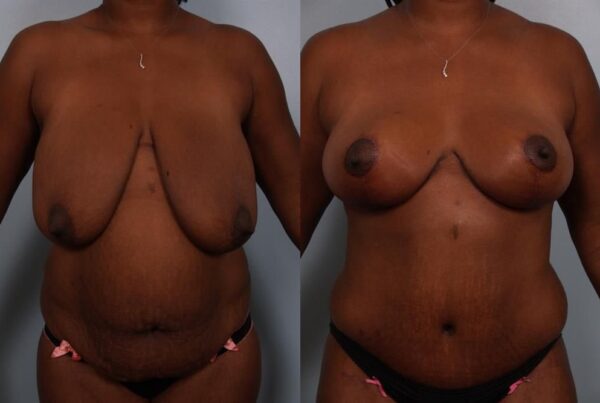 Breast Reduction 64