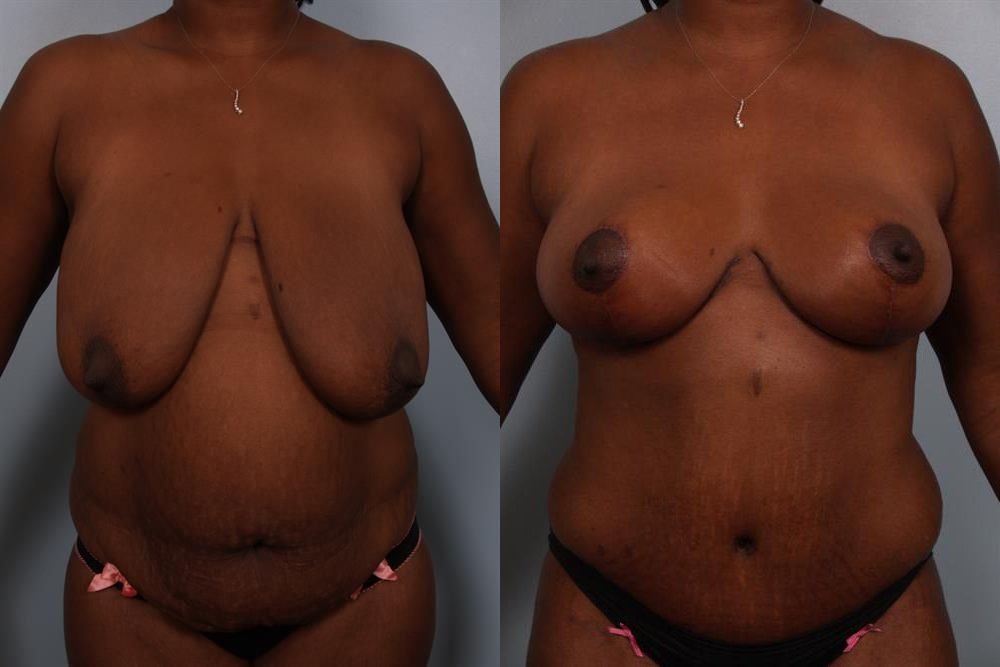 Breast Reduction 64