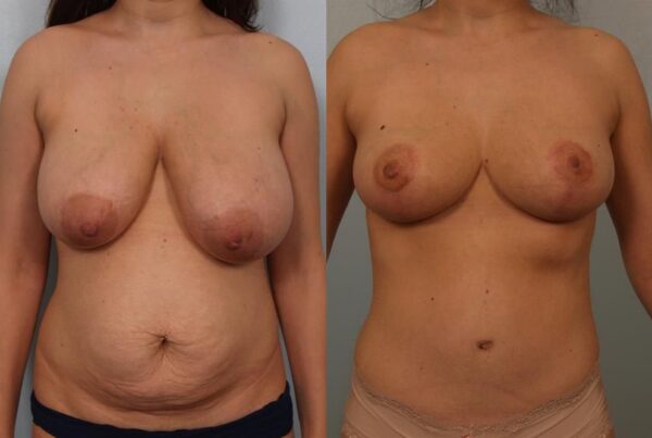 Breast Reduction 7