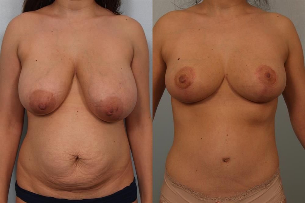 Breast Reduction 7