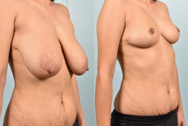 Breast Reduction 8