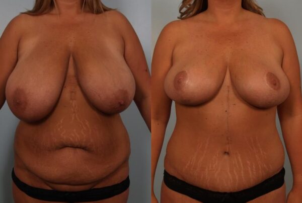 Breast Reduction 9