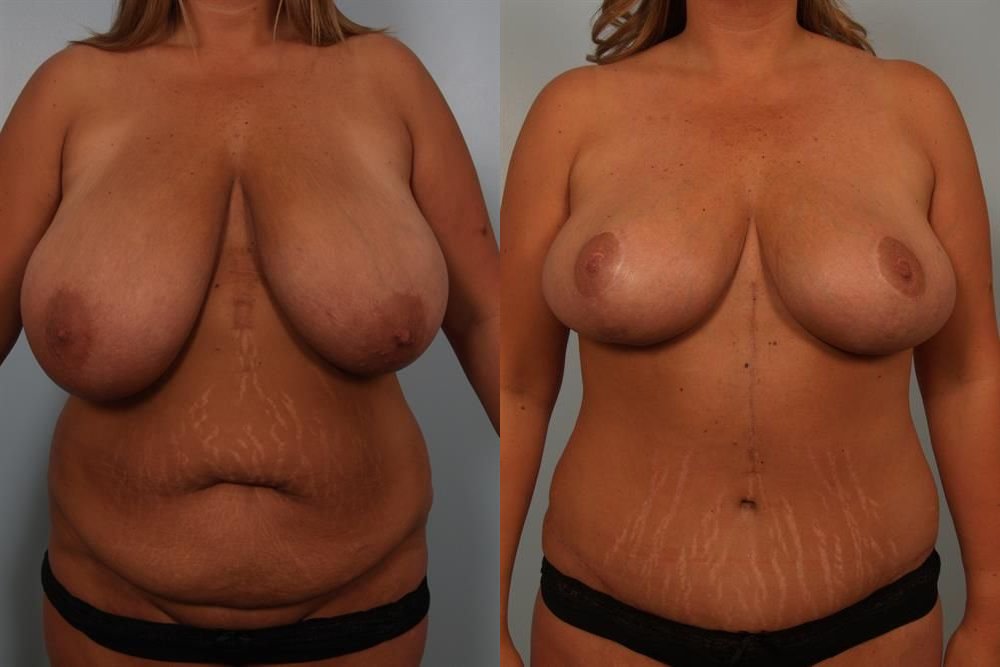 Breast Reduction 9