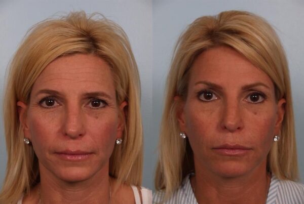 Brow Lift 1