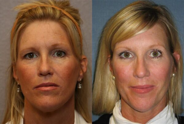 Brow Lift 2