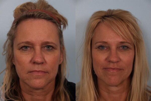 Brow Lift 3