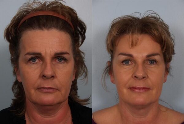Brow Lift 4