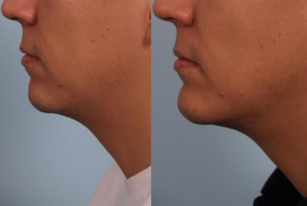 Chin Augmentation 1