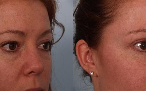 Eyelid Surgery 1