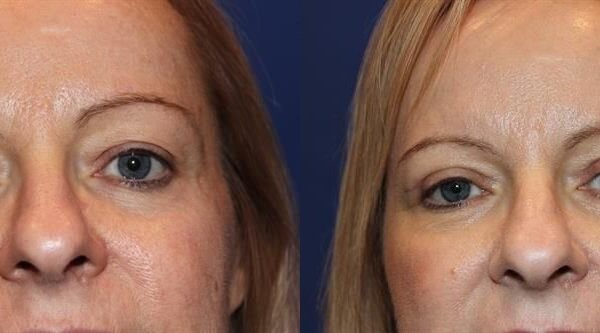 Eyelid Surgery 10