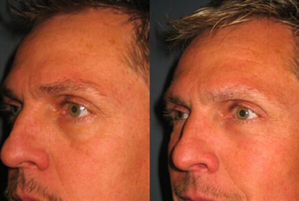 Eyelid Surgery 11