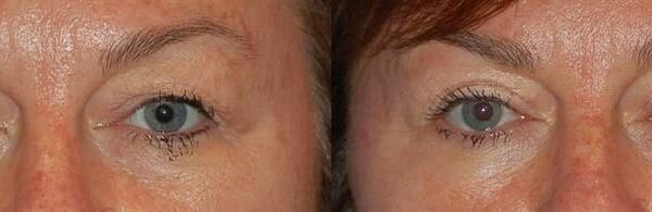 Eyelid Surgery 12