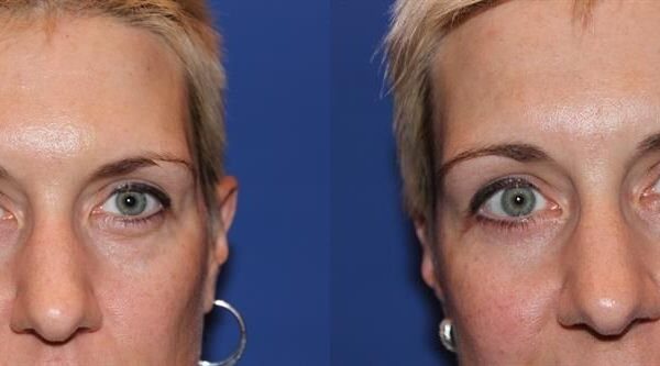 Eyelid Surgery 13