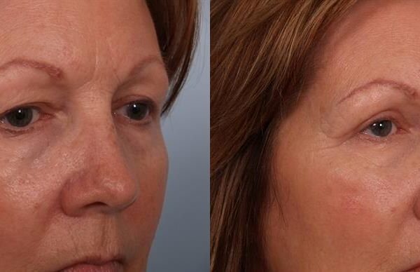 Eyelid Surgery 2