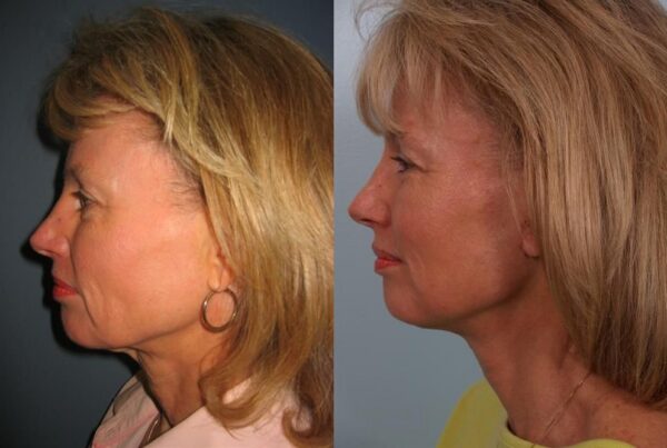Eyelid Surgery 3