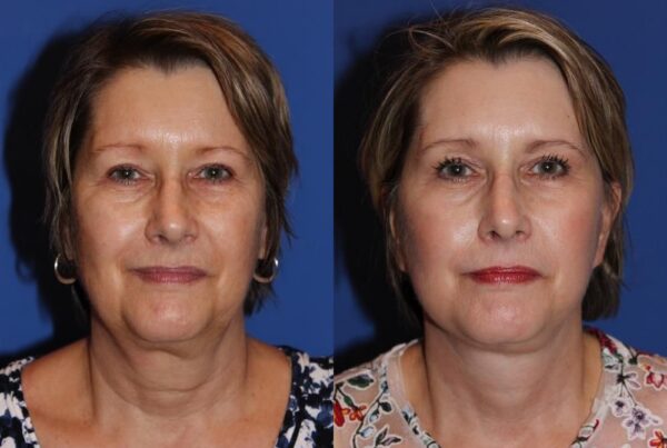 Eyelid Surgery 4