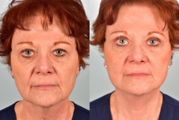 Eyelid Surgery 5