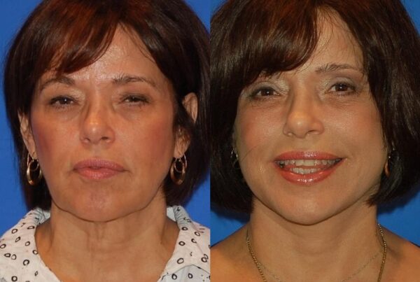 Eyelid Surgery 6