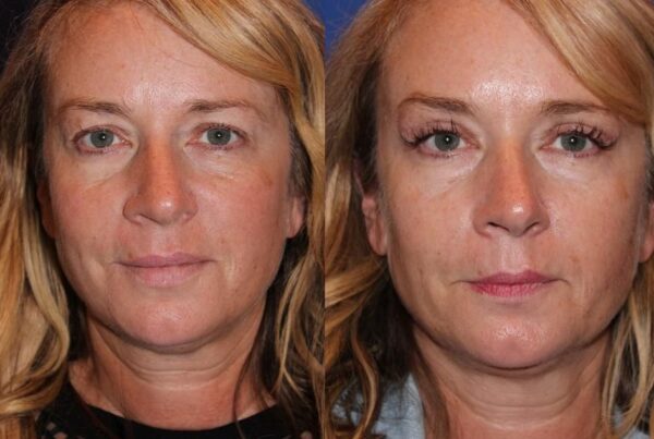 Eyelid Surgery 7