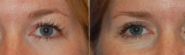 Eyelid Surgery 8