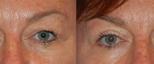Eyelid Surgery 9