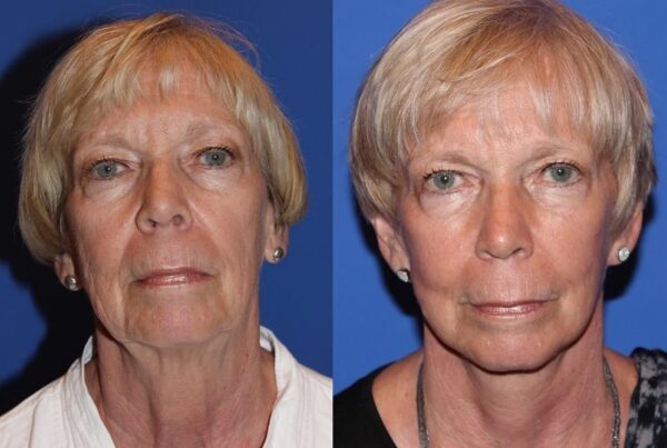 Facelift/Necklift 1
