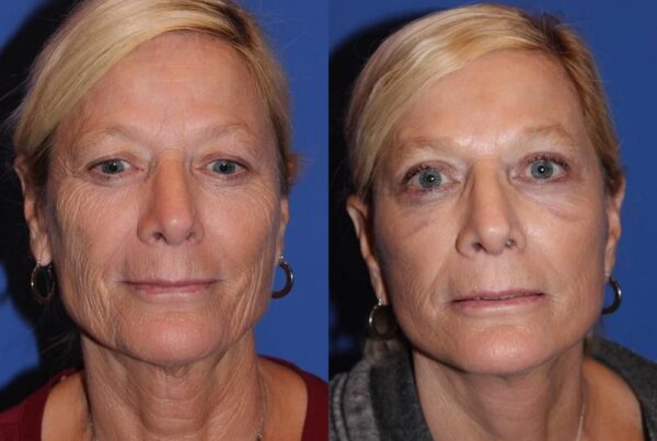 Facelift/Necklift 2