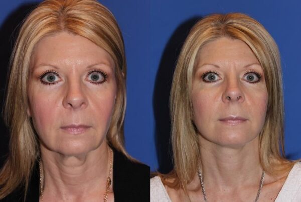 Facelift/Necklift 3