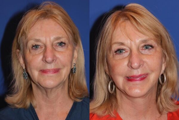 Facelift/Necklift 4