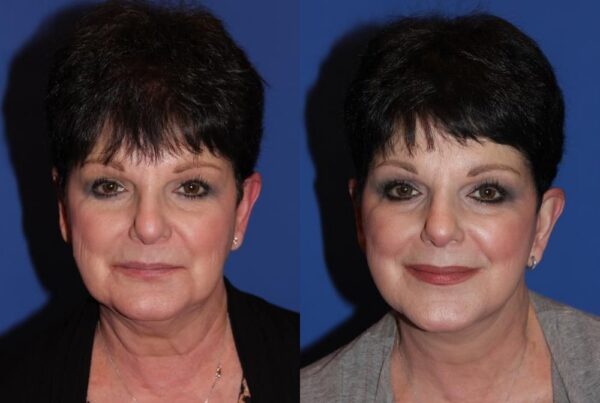 Facelift/Necklift 5