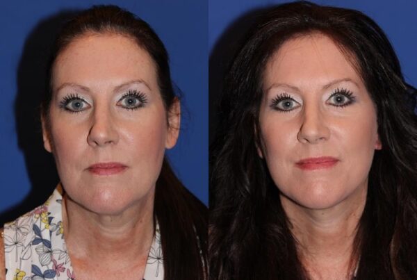 Facelift/Necklift 6