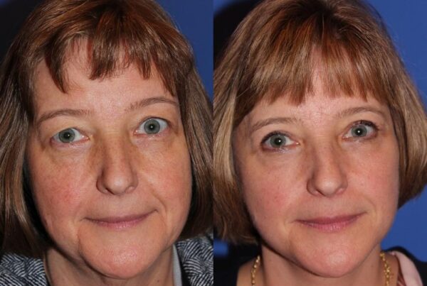 Facelift/Necklift 7