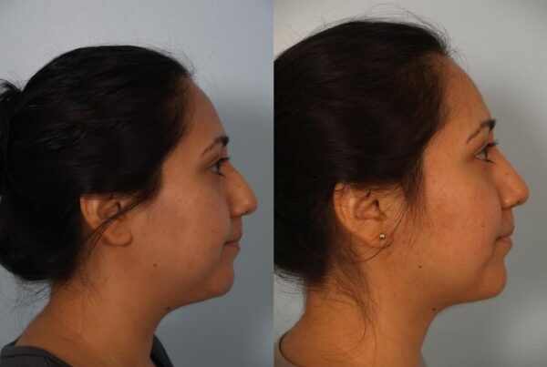 Facial Liposuction 1