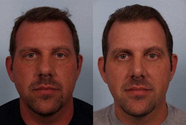 Facial Surgery 1