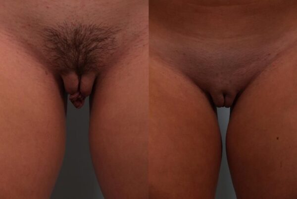 Labia Reduction 1