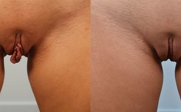 Labia Reduction 2