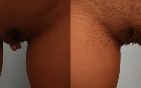 Labia Reduction 3