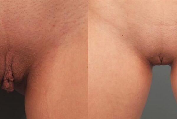 Labia Reduction 4