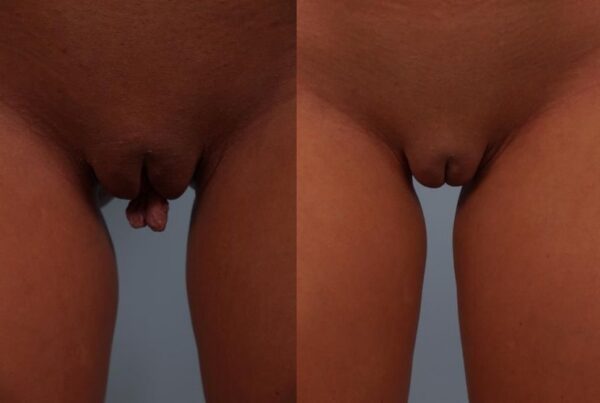 Labia Reduction 5