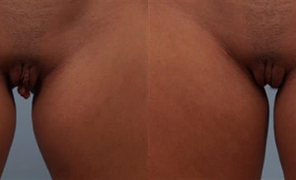 Labia Reduction 6