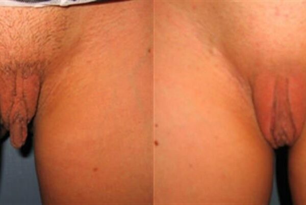Labia Reduction 7