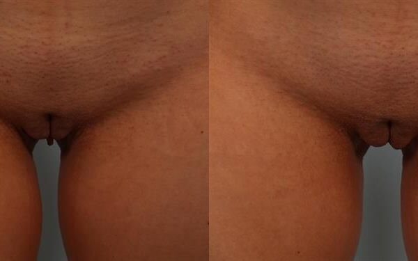 Labia Reduction 8