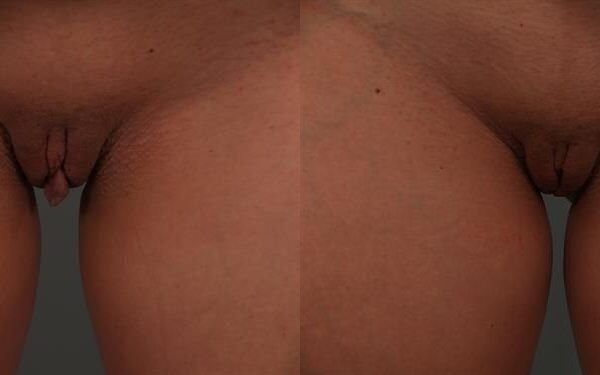 Labia Reduction 9
