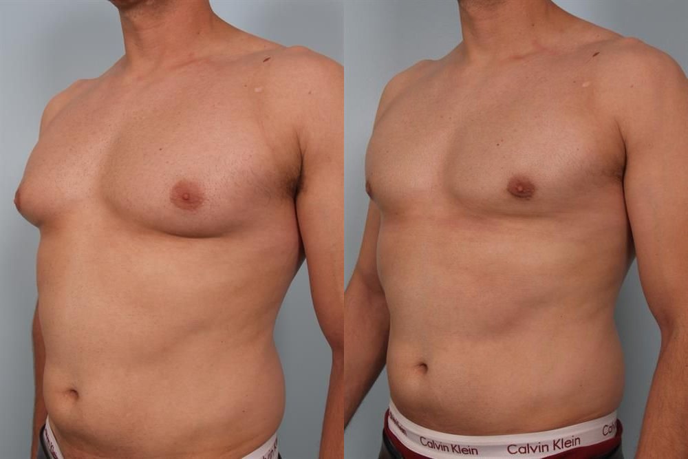 Male Breast/Areola Reduction 1